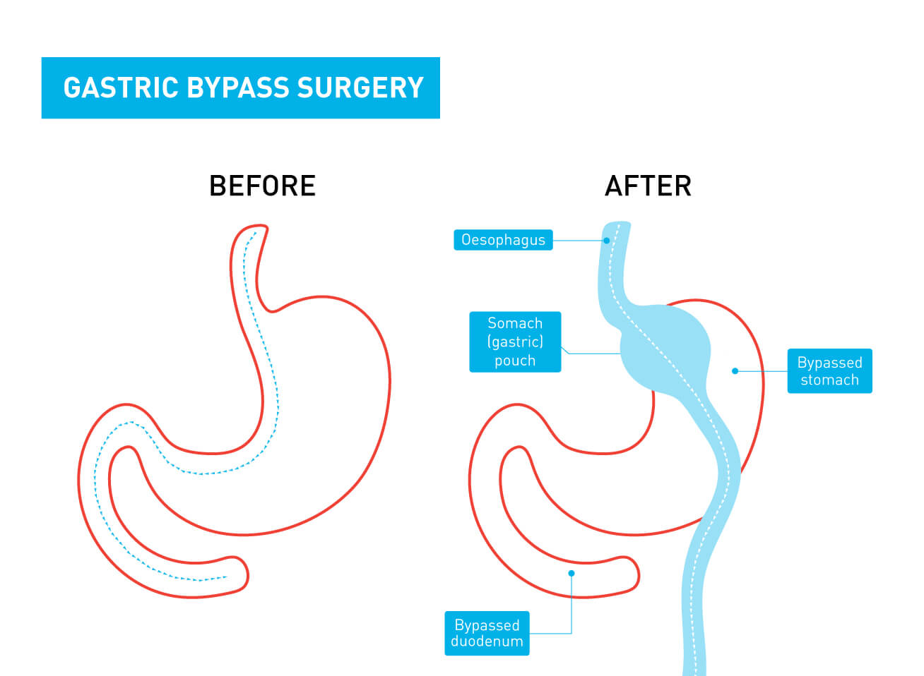 A graphic showing the difference between a stomach before and after gastric bypass surgery A graphic showing the difference between a stomach before and after gastric bypass surgery