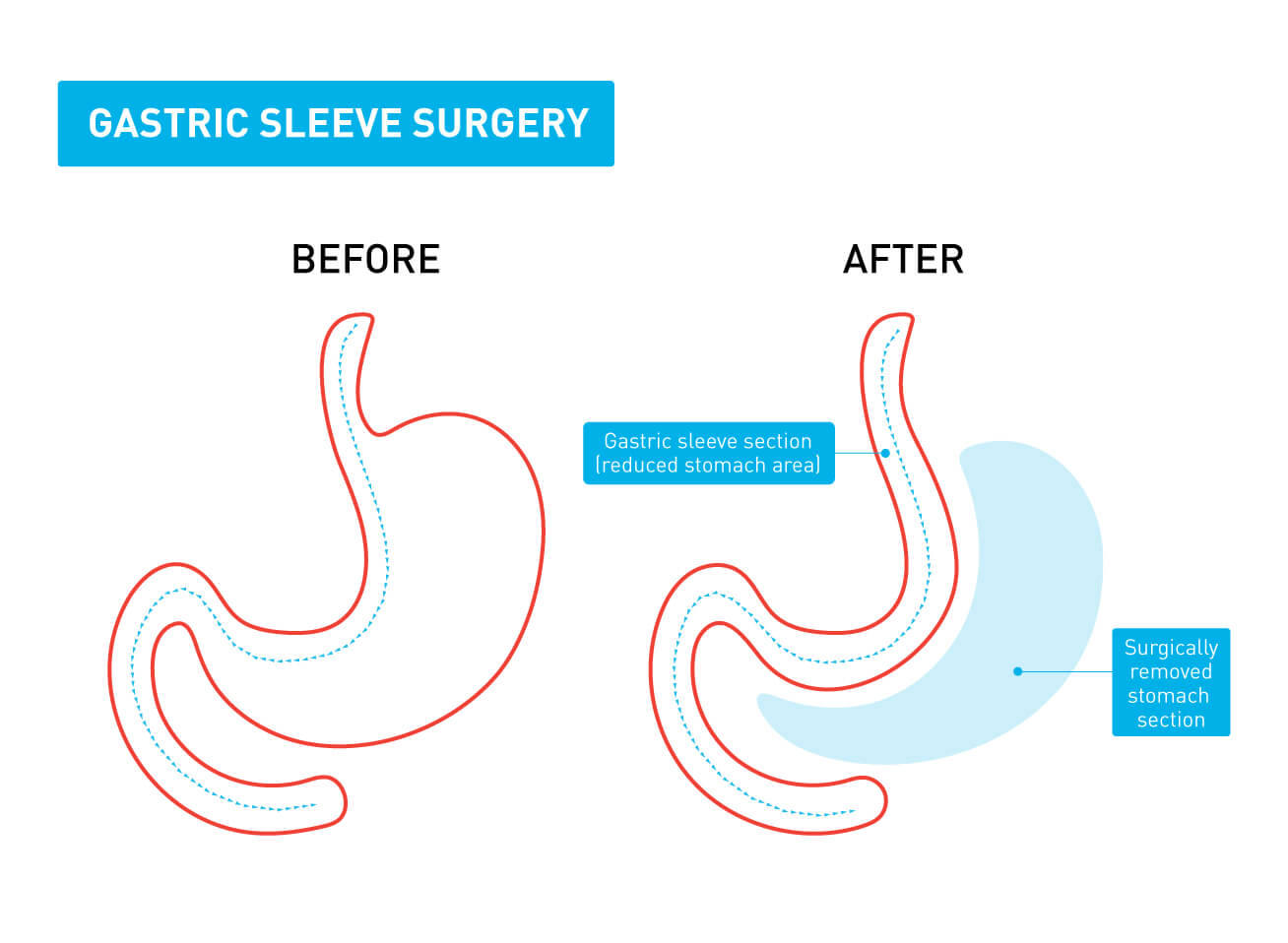 A graphic showing the difference between a stomach before and after gastric sleeve surgery A graphic showing the difference between a stomach before and after gastric sleeve surgery
