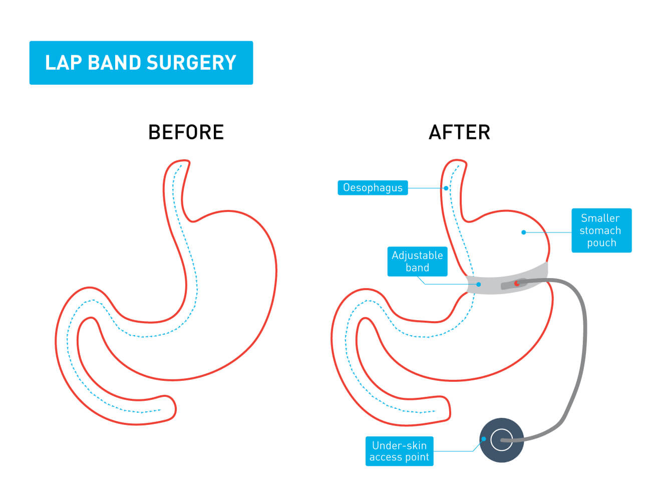 A graphic showing the difference between a stomach before and after lap band surgery A graphic showing the difference between a stomach before and after lap band surgery
